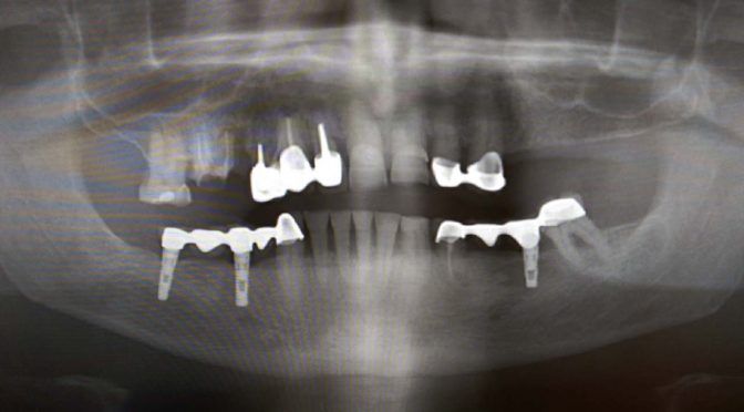 Innovatív, huszonegyedik századi fogimplantátum